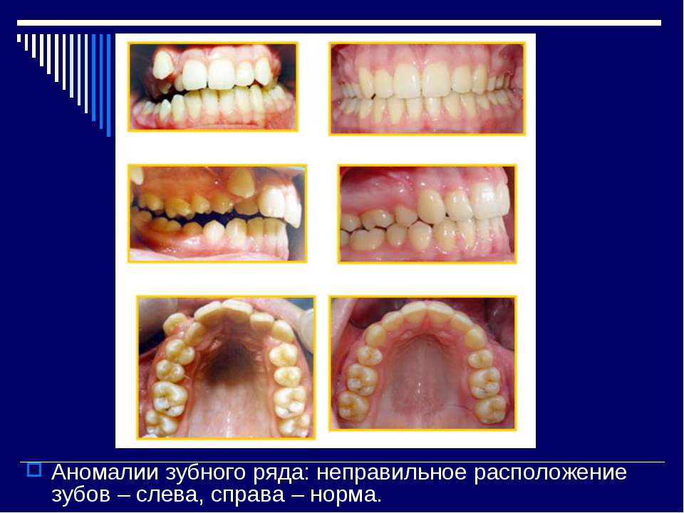 Нарушение строения зубов Нарушение строения зубов