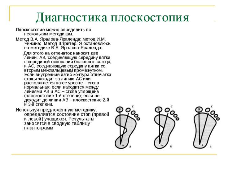 Как определить степень плоскостопии в домашних условиях