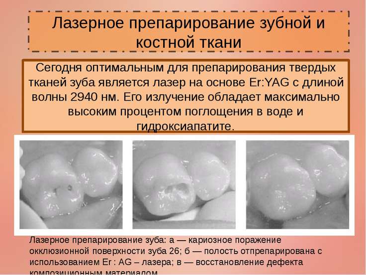 Принцип препарирования твердых тканей зуба Принцип препарирования твердых тканей зуба