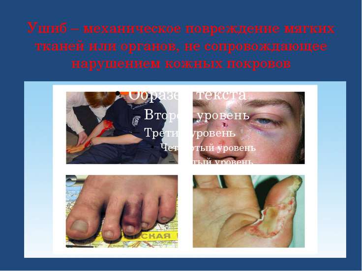 Ушиб мягких тканей в домашних условиях Ушиб мягких тканей в домашних условиях