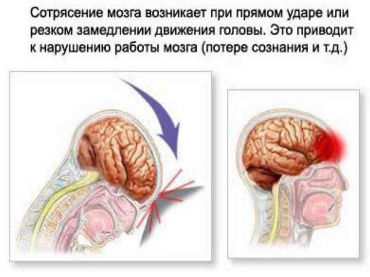 Сотрясение мозга та его симптомы и как его лечить Сотрясение мозга та его симптомы и как его лечить