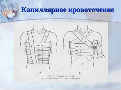 Капиллярное кровотечение рисунок