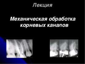 Механическая обработка корневых каналов