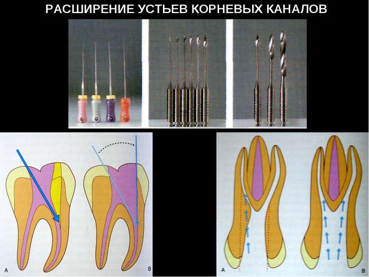 Ирригация корневых каналов презентация