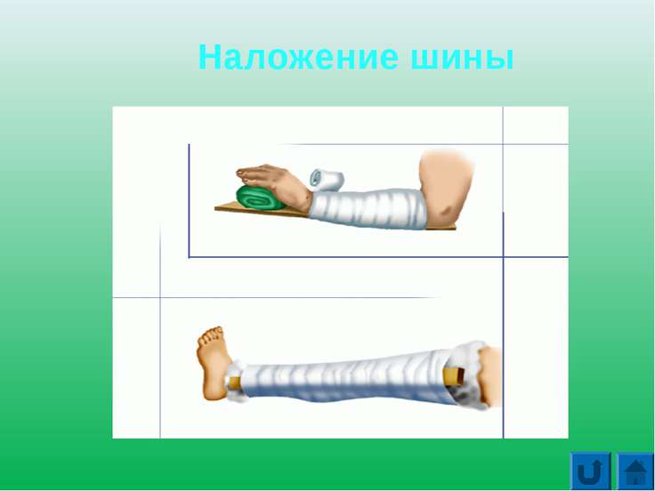 Оказание первой помощи при повреждении скелета мышц. Оказание первой помощи при повреждении скелета. Наложение шины восьмеркой.