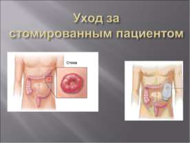 Уход за стомированным пациентом
