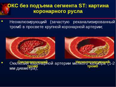 ОКС без подъема сегмента ST: картина коронарного русла Неокклюзирующий (зачас...