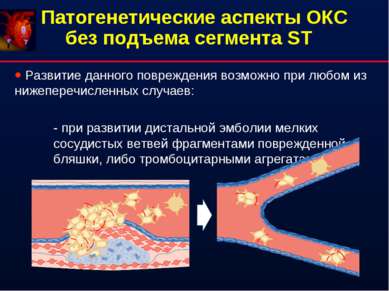 Патогенетические аспекты ОКС без подъема сегмента ST Развитие данного поврежд...