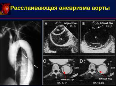 Расслаивающая аневризма аорты