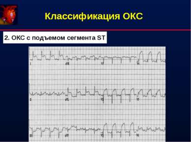 Классификация ОКС 2. ОКС с подъемом сегмента ST