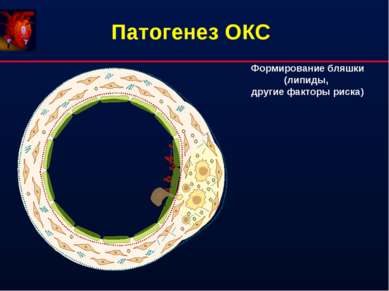 Патогенез ОКС Формирование бляшки (липиды, другие факторы риска)