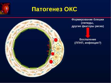 Патогенез ОКС Формирование бляшки (липиды, другие факторы риска) Воспаление (...