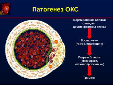 Патогенез ОКС Формирование бляшки (липиды, другие факторы риска) Воспаление (...