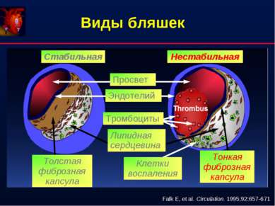 Виды бляшек Falk E, et al. Circulation. 1995;92:657-671 Стабильная Нестабильн...