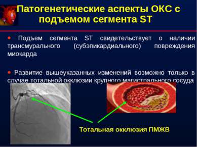 Патогенетические аспекты ОКС с подъемом сегмента ST Подъем сегмента ST свидет...