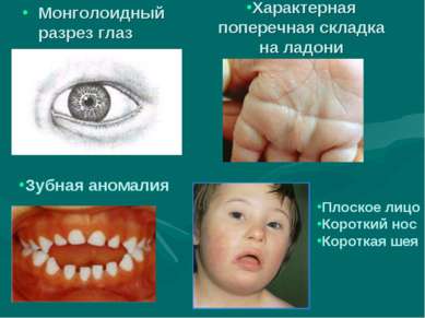 Характерная поперечная складка на ладони Монголоидный разрез глаз Зубная аном...