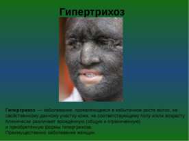 Гипертрихоз 