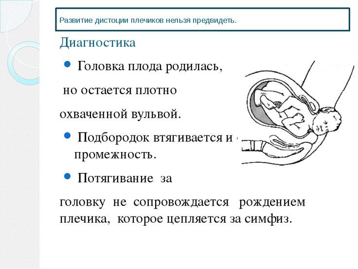 Положения головки плода. Дистоция плечиков плода. Циркулярная дистоция матки. Дистоция плечиков в родах. Дистоция плечиков мкб 10.