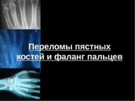 Переломы пястных костей и фаланг пальцев
