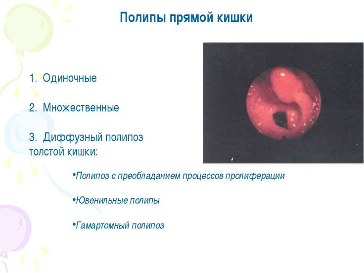 Полип в слепой кишке что это может быть